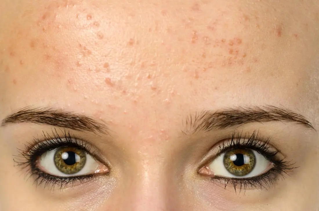 japan pimple cream