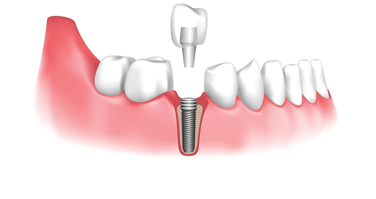Dental Implants